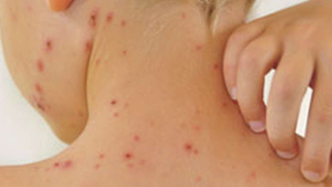 "Bulaşıcılığı ve ölümcüllüğü yüksek olan kızamıktan korunmanın yolu aşı olmaktan geçiyor"